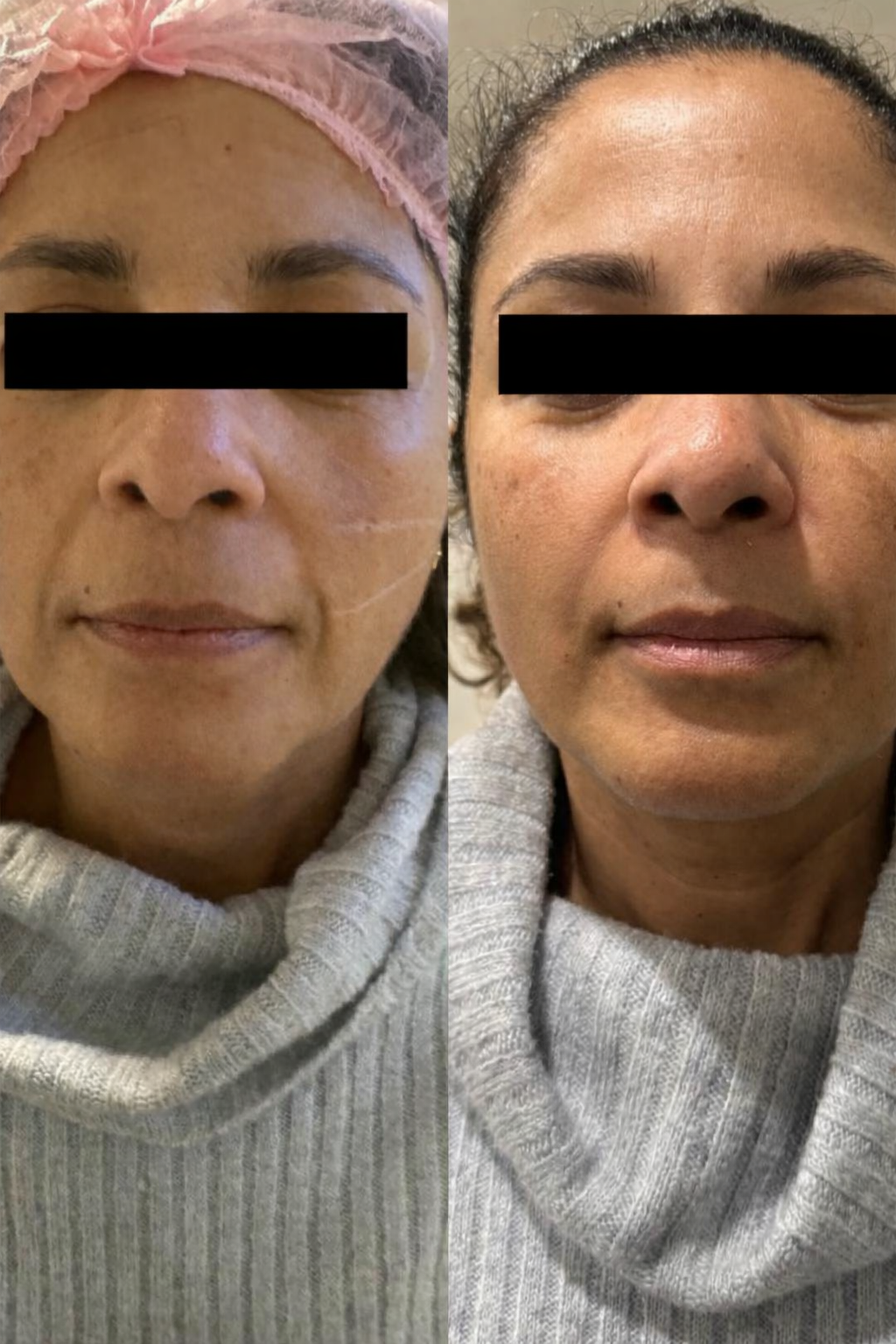 Refinamento das linhas e da textura. Comparativo com depois à esquerda e antes à direita.