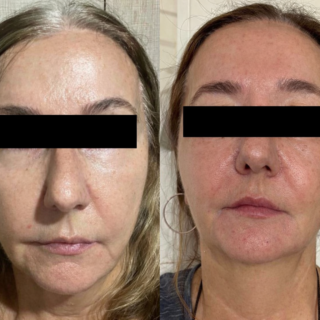 Melhora do viço e da uniformidade. Comparativo com depois à esquerda e antes à direita.